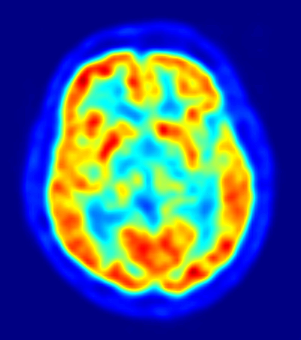 pet scan of brain