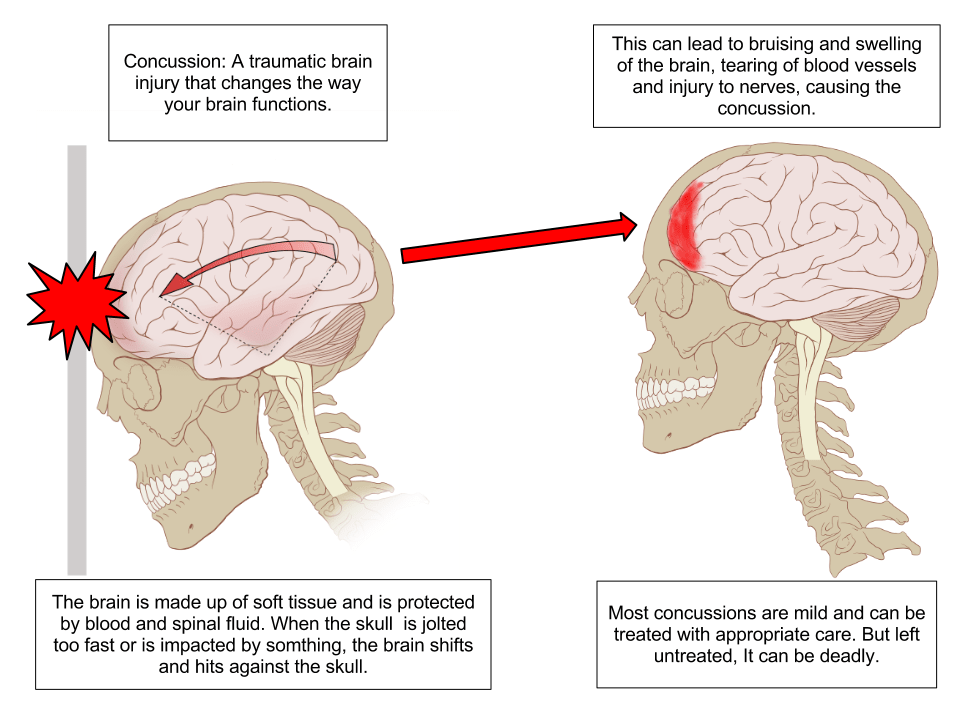 concussion illustration