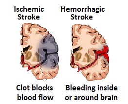 ischemic and hemorraghic stroke brain map